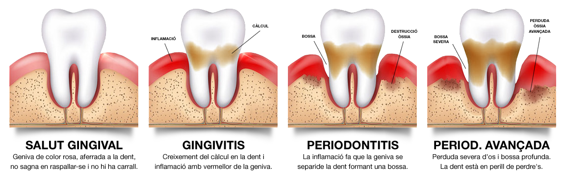 Periodontitis-Gengivitis-Fases-Clinica-Aureo-Palma-de-Mallorca-CA