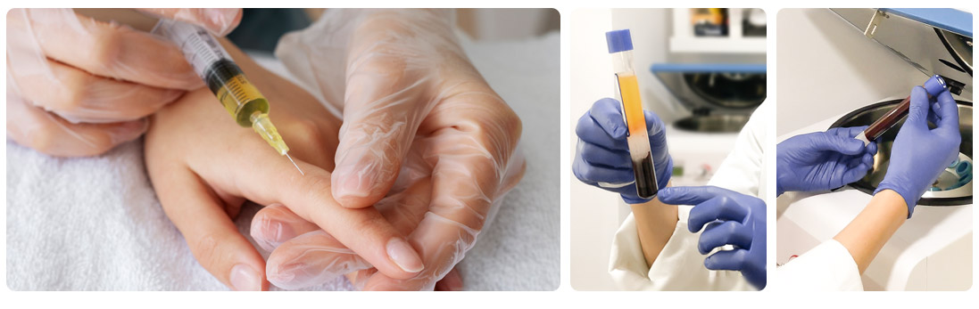 PRP Platelet-Rich Plasma