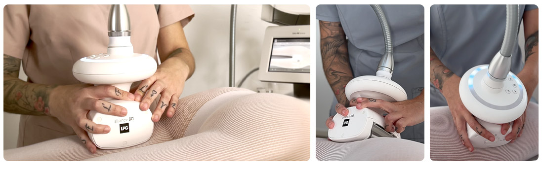 LPG Endermologie